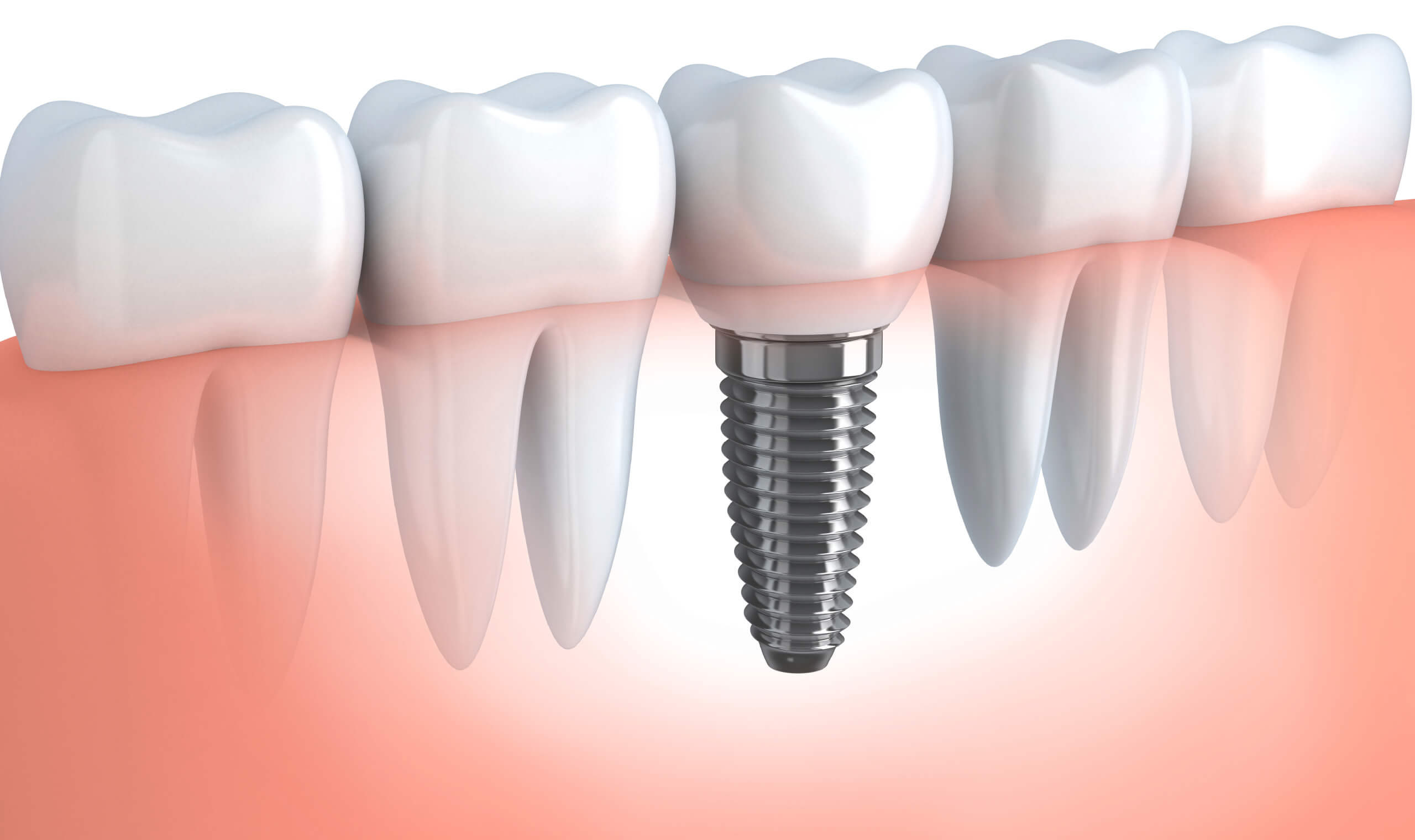 Dental Implant Renfrew Ontario